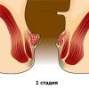 Stages Stages of hemorrhoids and their treatment