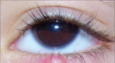 Psychosomatics, stye: causes, symptoms, treatment, recommendations and opinions of doctors