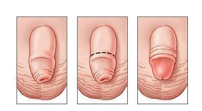 Adhesive (adhesive) balanoposthitis Bacterial balanoposthitis in men